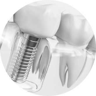 Dr Benjamin Attuil conseil implant dentaire Paris 11